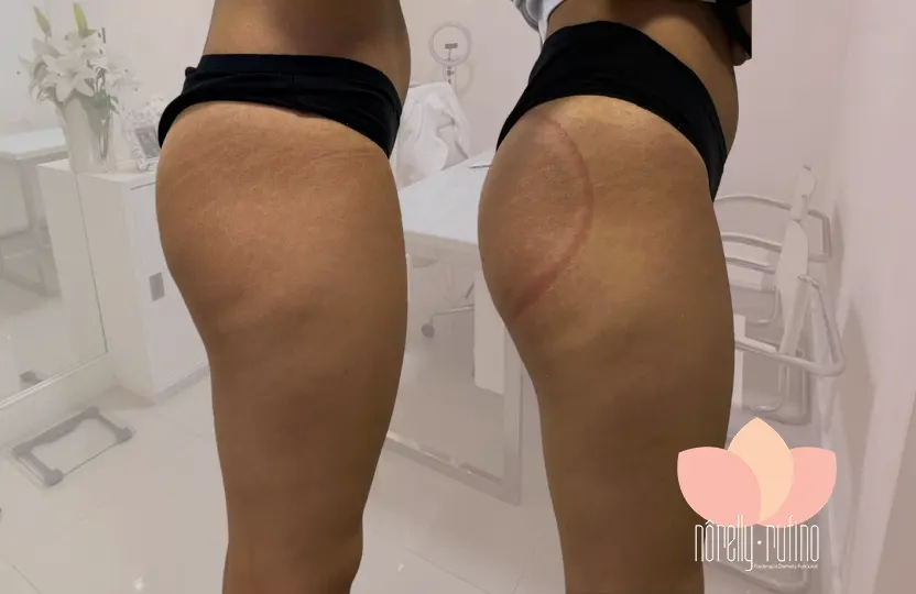 slide-site-gluteos-3